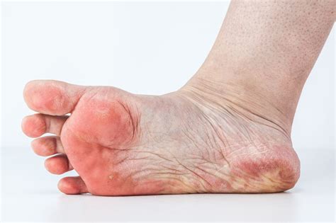 pés descascando diabetes